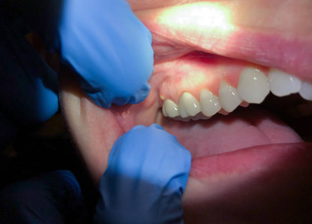 Best Emergency Root Canal Treatment in Seabrook Farms, NJ